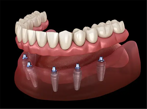 ALL-ON-X DENTAL IMPLANTS